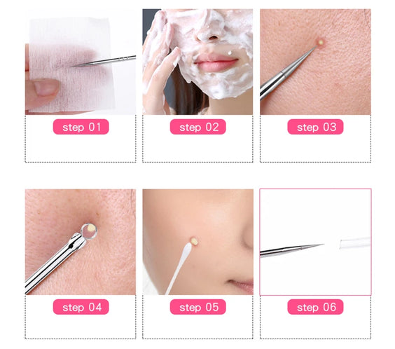 Stainless Blackhead Extractor