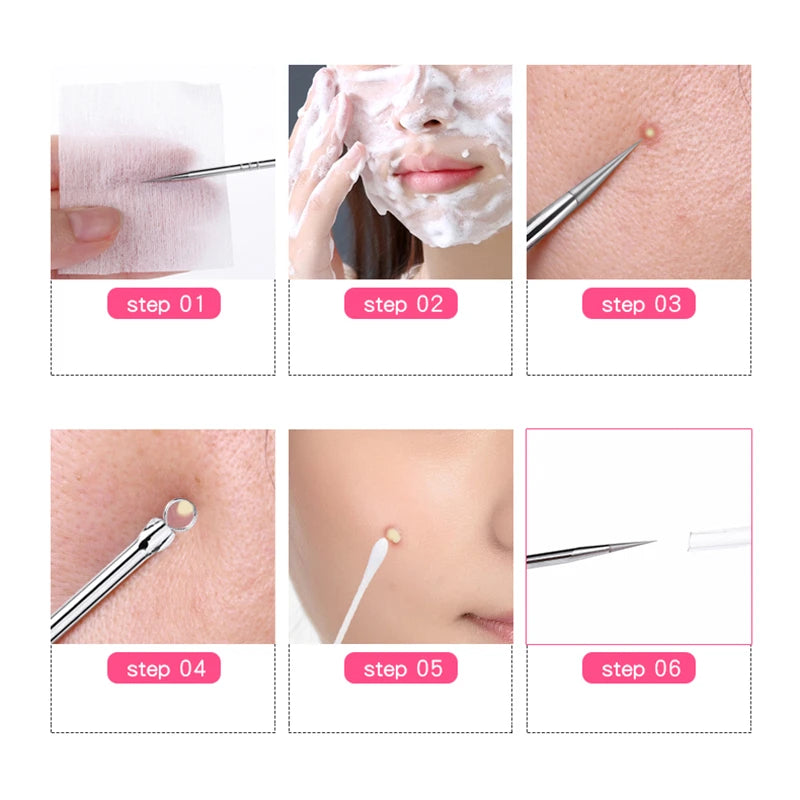 Stainless Blackhead Extractor - Beauty Bae
