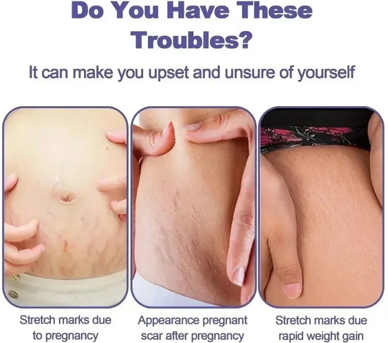 Stretch Mark Repair Cream