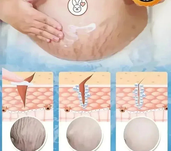 Stretch Mark Repair Cream