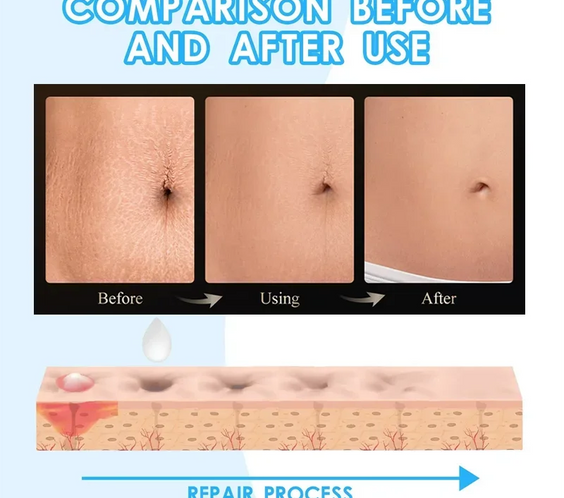 Stretch Mark Repair Cream