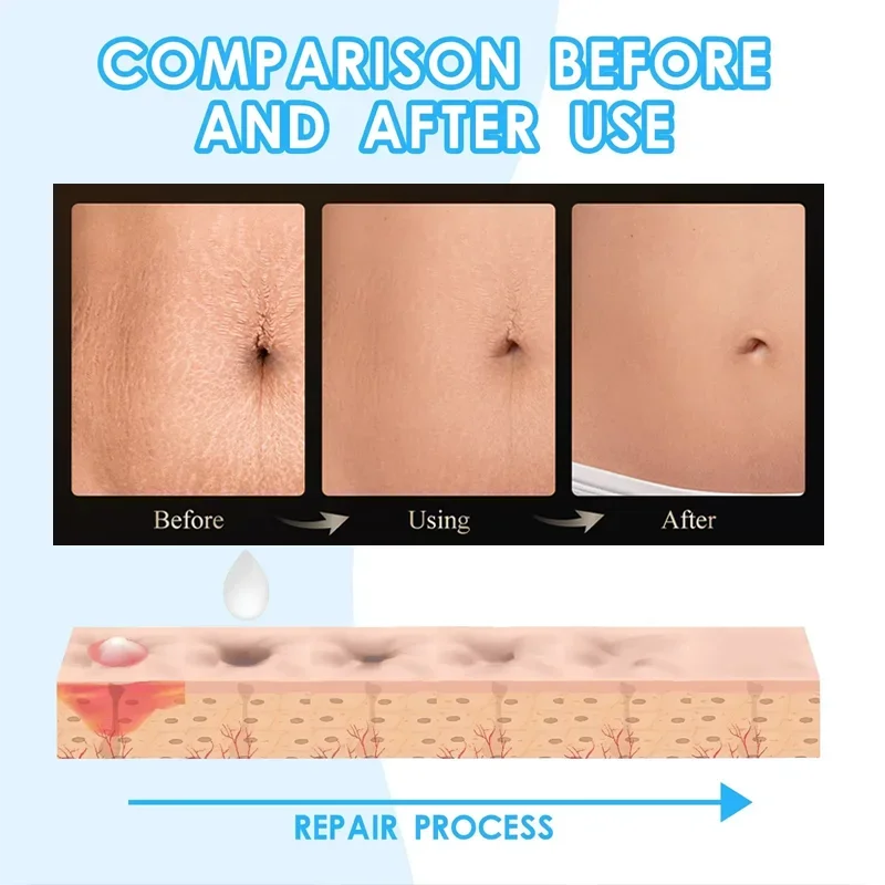 Stretch Mark Repair Cream
