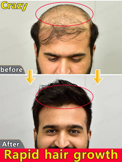 Hair Growth Kit 2025 Scalp with topical serum bottle and precision applicator labeled peptide vitamins fragrance-free option