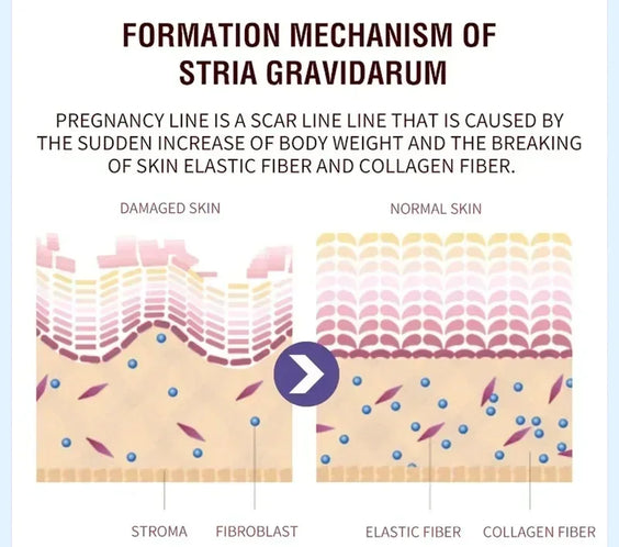 Stretch Mark Repair Cream