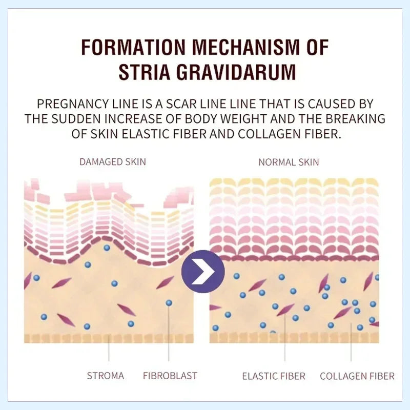 Stretch Mark Repair Cream - Beauty Bae